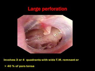 Large perforation
 
