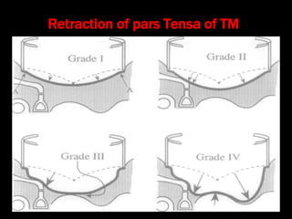 Retraction of pars Tensa of TM
 