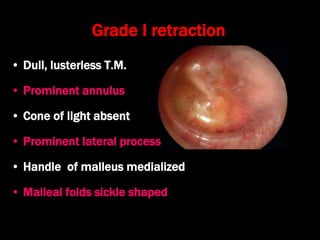 Grade I retraction
• Dull, lusterless T.M.
• Prominent annulus
• Cone of light absent
• Prominent lateral process
• Handle of malleus medialized
• Malleal folds sickle shaped
 