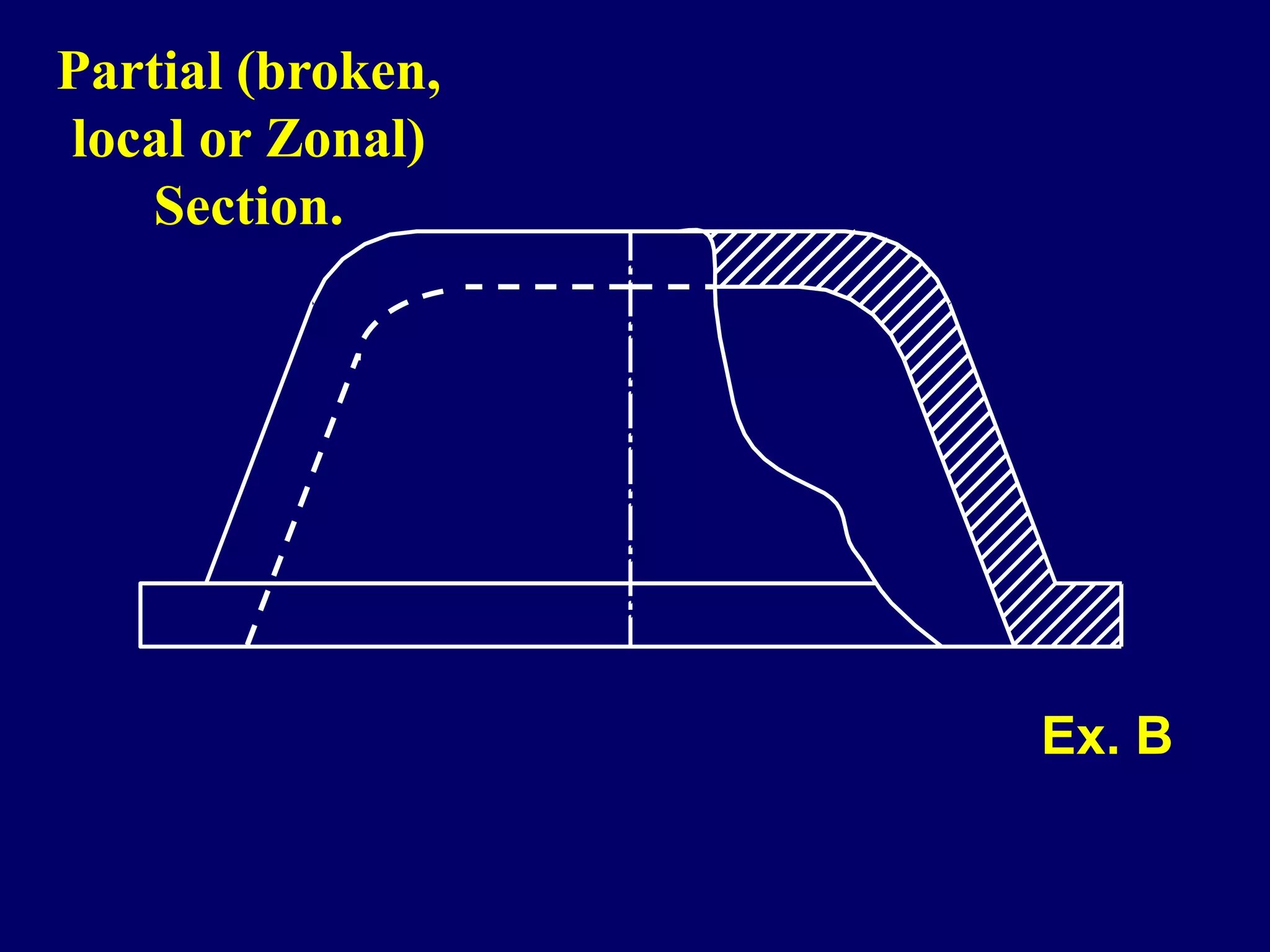 Partial (broken,
local or Zonal)
Section.
Ex. B
 