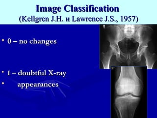 Osteoarthritis & Spondylitis | PPT