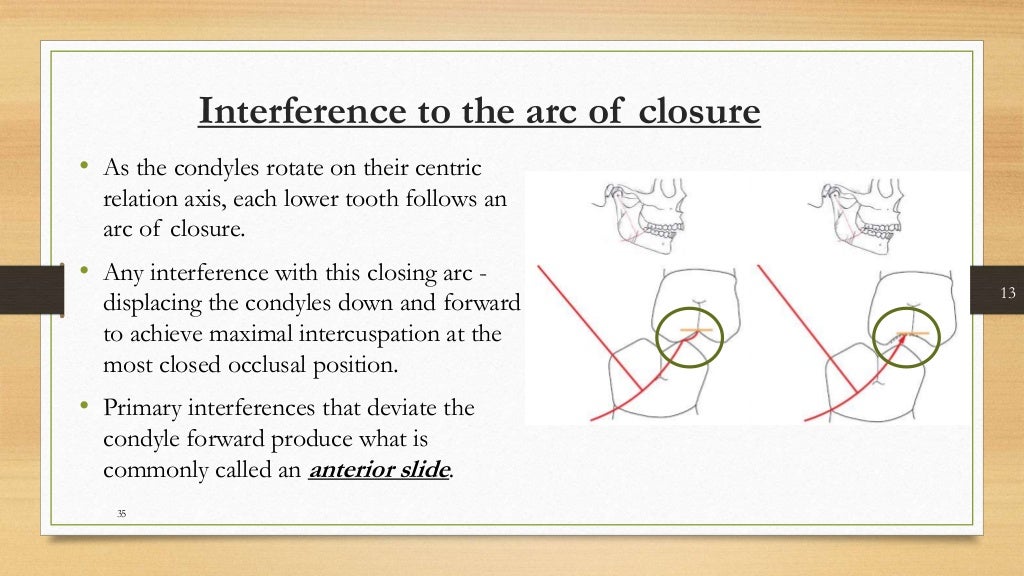 Occlusal equilibration Kelly