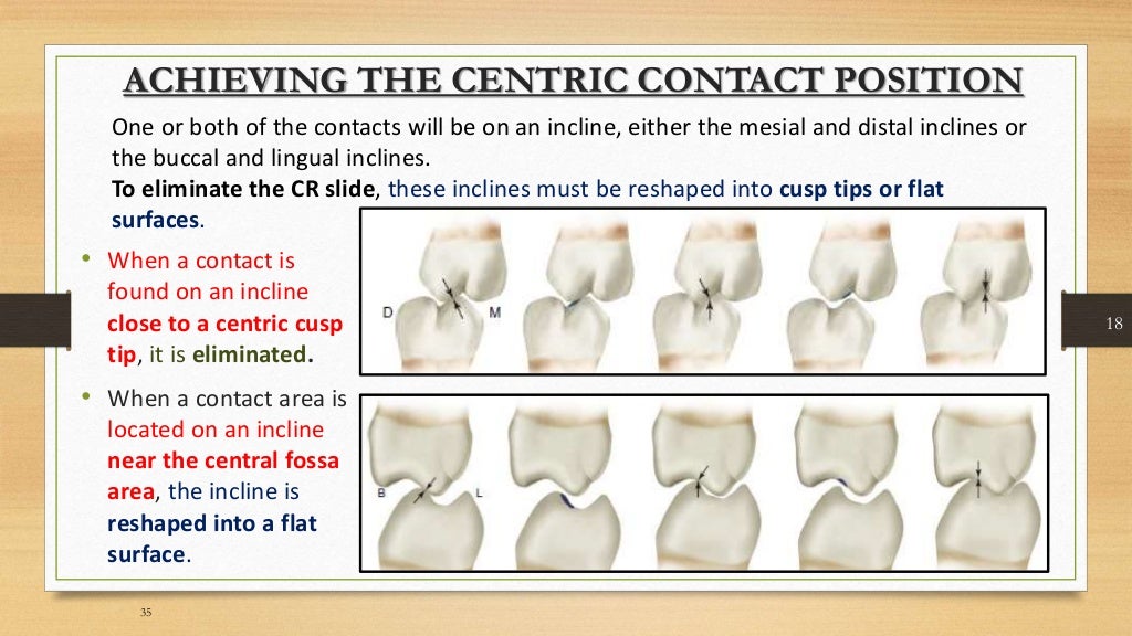 Occlusal equilibration Kelly