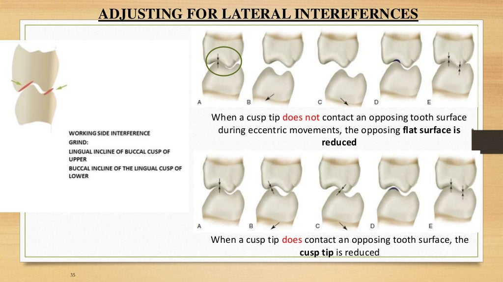 Occlusal equilibration Kelly
