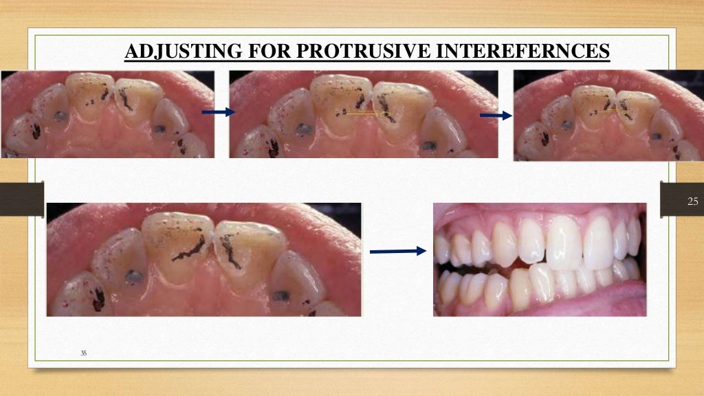 Occlusal equilibration Kelly