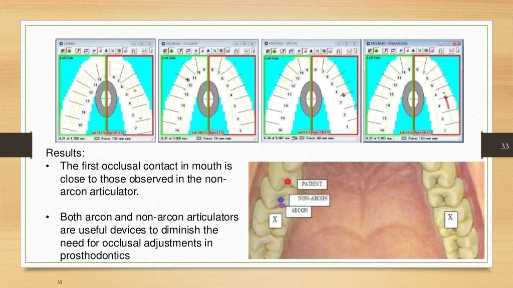 Occlusal equilibration Kelly