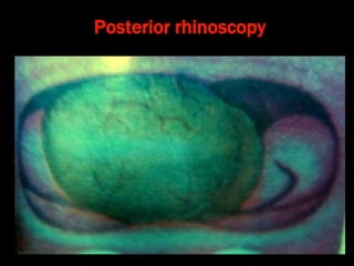 Posterior rhinoscopy
 