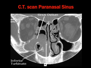 C.T. scan Paranasal Sinus
 