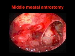 Middle meatal antrostomy
 