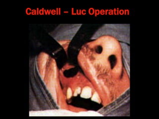 Caldwell – Luc Operation
 