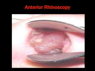 Anterior Rhinoscopy
 