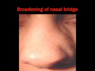 Broadening of nasal bridge
 
