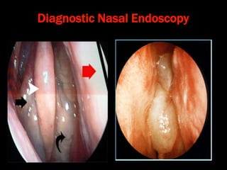 Diagnostic Nasal Endoscopy
 