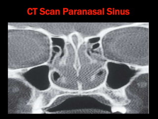 CT Scan Paranasal Sinus
 