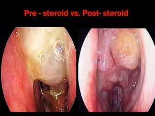 Pre - steroid vs. Post- steroid
 