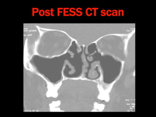 Post FESS CT scan
 