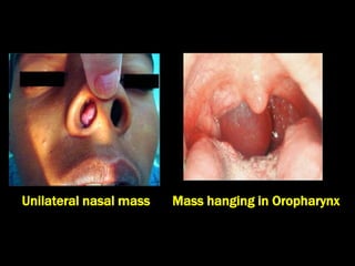 Mass hanging in OropharynxUnilateral nasal mass
 