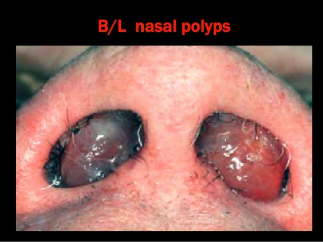 obstructive nasal polyps