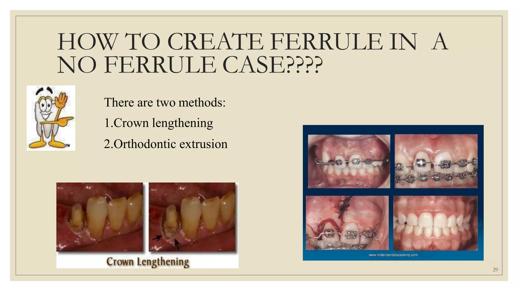 HOW TO CREATE FERRULE IN A
NO FERRULE CASE????
There are two methods:
1.Crown lengthening
2.Orthodontic extrusion
29
 