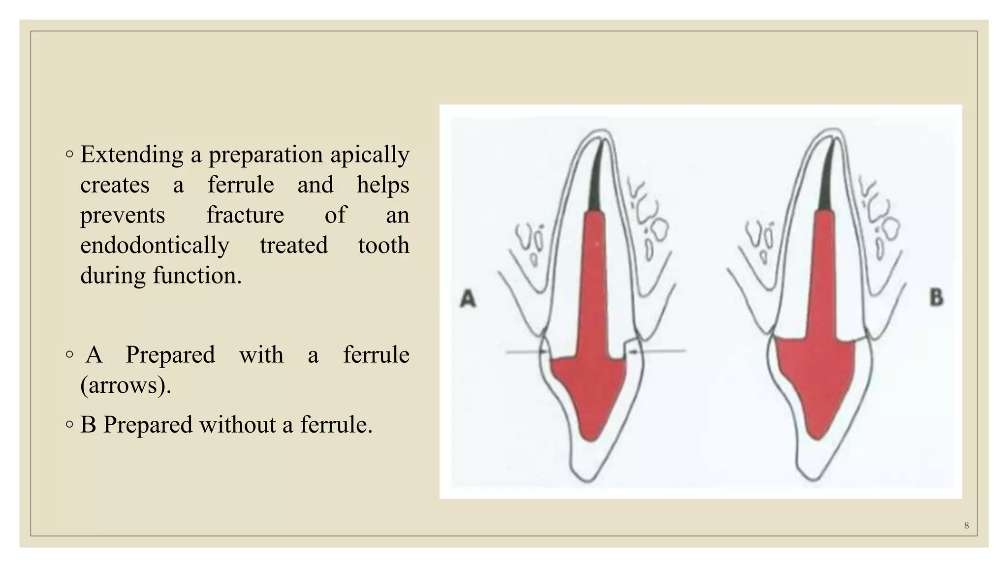 ◦ Extending a preparation apically
creates a ferrule and helps
prevents fracture of an
endodontically treated tooth
during function.
◦ A Prepared with a ferrule
(arrows).
◦ B Prepared without a ferrule.
8
 