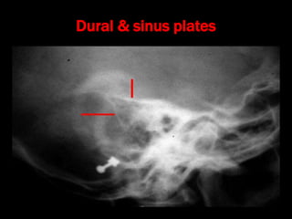 14. chronic suppurative otitis media attico antral disease | PPT