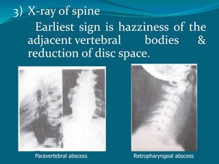 3) X-ray of spine
Earliest sign is hazziness of the
adjacent vertebral bodies &
reduction of disc space.
Paravertebral abscess Retropharyngeal abscess
 