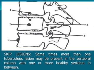 SKIP LESIONS: Some times more than one
tuberculous lesion may be present in the vertebral
column with one or more healthy vertebra in
between.
 