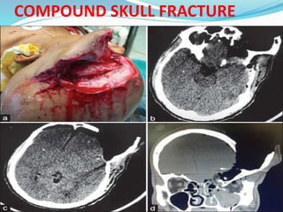 COMPOUND SKULL FRACTURE
 