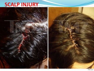 SCALP INJURY
 