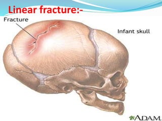 Linear fracture:-
 