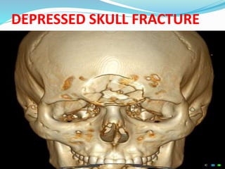 DEPRESSED SKULL FRACTURE
 