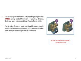 • The prototypes of the first active self-ligating bracket
(SPEED-Spring-loaded,Precision, Edgewise, Energy,
Delivery) were introduced into the market in 1980.
• The bracket features a curved, flexible super-elastic
nickel-titanium spring clip that embraces the bracket
body and passes through the archwire slot.
SPEED brackets in open &
closed position
5/24/2021 19
 
