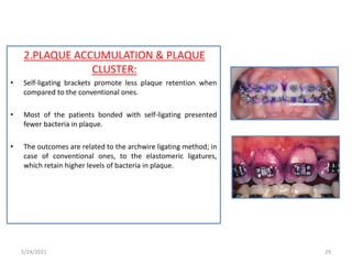 2.PLAQUE ACCUMULATION & PLAQUE
CLUSTER:
• Self-ligating brackets promote less plaque retention when
compared to the conventional ones.
• Most of the patients bonded with self-ligating presented
fewer bacteria in plaque.
• The outcomes are related to the archwire ligating method; in
case of conventional ones, to the elastomeric ligatures,
which retain higher levels of bacteria in plaque.
5/24/2021 29
 