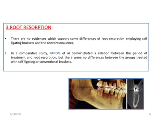 3.ROOT RESORPTION:
• There are no evidences which support some differences of root resorption employing self
ligating brackets and the conventional ones.
• In a comparative study, PANDIS et al demonstrated a relation between the period of
treatment and root resorption, but there were no differences between the groups treated
with self-ligating or conventional brackets.
5/24/2021 30
 