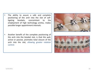 • The ability to assure a safe and complete
positioning of the arch into the slot of self-
ligating brackets, concomitant to the
employment of high technology arches, makes
possible longer appointment intervals.
• Another benefit of the complete positioning of
the arch into the bracket slot, is that the wall,
active or passive, promotes total closure of the
arch into the slot, allowing greater rotation
control.
5/24/2021 33
 