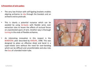 3.Prevention of wire pokes:
• The very low friction with self-ligating brackets enables
aligning archwires to slip through the brackets and an
archwire end to protrude.
• This is clearly a potential nuisance which can be
avoided by using tie-backs with flexible wires over
extraction sites to lessen the effects of occlusal forces
on unprotected spans of wire. Another way is thorough
turning in the ends of flexible archwires.
• An interesting innovation in this respect is the
BENDISTAL plier described by KHOURI, 1998. This was
designed to place an effective distal end bend in a
super-elastic wire without the need for over-bending
which can be difficult and uncomfortable and also risks
the loss of a bonded molar tube.
5/24/2021 42
 