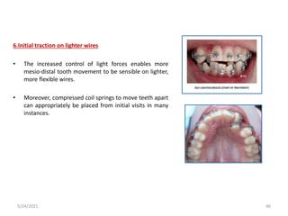 6.Initial traction on lighter wires
• The increased control of light forces enables more
mesio-distal tooth movement to be sensible on lighter,
more flexible wires.
• Moreover, compressed coil springs to move teeth apart
can appropriately be placed from initial visits in many
instances.
5/24/2021 46
 