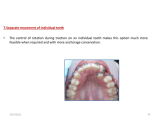 7.Separate movement of individual teeth
• The control of rotation during traction on an individual tooth makes this option much more
feasible when required and with more anchorage conservation.
5/24/2021 47
 