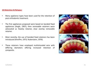10.Retention & Relapse:
• Many appliance types have been used for the retention of
post orthodontic treatment.
• The first appliances proposed were based on banded fixed
appliances (Angle, 1907), then removable retainers were
advocated as Hawley retainer, clear overlay removable
retainer.
• Most recently, the use of bonded fixed retainers has been
introduced (Kneiflm, 1973; Rubenstein, 1976).
• These retainers have employed multistranded wire with
differing diameters offering increased retention of
composite.
5/24/2021 51
 