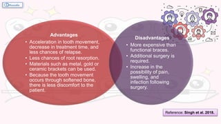 Advantages
• Acceleration in tooth movement,
decrease in treatment time, and
less chances of relapse.
• Less chances of root resorption.
• Materials such as metal, gold or
ceramic brackets can be used.
• Because the tooth movement
occurs through softened bone,
there is less discomfort to the
patient.
Disadvantages
• More expensive than
functional braces.
• Additional surgery is
required.
• Increase in the
possibility of pain,
swelling, and
infection following
surgery.
Reference: Singh et al. 2018.
 