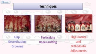 Techniques
Particulate
Bone Grafting
Flap;
Decortication;
Grooving
Flap Closure
and
Orthodontic
Adjustments
 