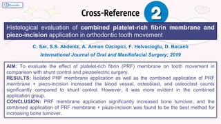 Cross-Reference
C. Sar, S.S. Akdeniz, A. Arman Ozcirpici, F. Helvacioglu, D. Bacanlı
International Journal of Oral and Maxillofacial Surgery; 2019
AIM: To evaluate the effect of platelet-rich fibrin (PRF) membrane on tooth movement in
comparison with shunt control and piezoelectric surgery.
RESULTS: Isolated PRF membrane application as well as the combined application of PRF
membrane + piezo-incision increased the blood vessel, osteoblast, and osteoclast counts
significantly compared to shunt control. However, it was more evident in the combined
application group.
CONCLUSION: PRF membrane application significantly increased bone turnover, and the
combined application of PRF membrane + piezo-incision was found to be the best method for
increasing bone turnover.
Histological evaluation of combined platelet-rich fibrin membrane and
piezo-incision application in orthodontic tooth movement
 