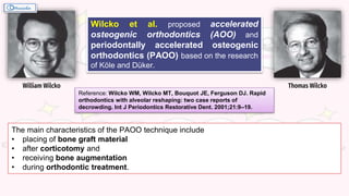 William Wilcko Thomas Wilcko
Wilcko et al. proposed accelerated
osteogenic orthodontics (AOO) and
periodontally accelerated osteogenic
orthodontics (PAOO) based on the research
of Köle and Düker.
The main characteristics of the PAOO technique include
• placing of bone graft material
• after corticotomy and
• receiving bone augmentation
• during orthodontic treatment.
Reference: Wilcko WM, Wilcko MT, Bouquot JE, Ferguson DJ. Rapid
orthodontics with alveolar reshaping: two case reports of
decrowding. Int J Periodontics Restorative Dent. 2001;21:9–19.
 