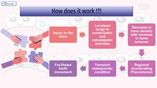 How does it work !?!
Injury to the
bone
Localised
surge in
osteoclastic
and
osteoblastic
activities
Decrease in
bone density
with increase
in bone
turnover
Regional
Accelerating
Phenomenon
Transient
osteoporotic
condition
Facilitates
tooth
movement
 