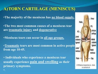 A)TORN CARTILAGE (MENISCUS)
•The majority of the meniscus has no blood supply.
•The two most common causes of a meniscus tear
are traumatic injury and degenerative
•Meniscus tears can occur in all age groups.
•Traumatic tears are most common in active people
from age 10-45.
• Individuals who experience a meniscus tear
usually experience pain and swelling as their
primary symptoms.
•.
 