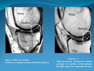 Figure 5: Side view of knee.
Circled area contains an area of normal meniscus.
Figure 6
Side view of knee. Circled area contains
an image of a portion of the meniscus.
The light center area represents the tear.
 
