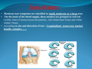 • Meniscus tear symptoms are classified as small, moderate or a large tear.
• On the basis of the blood supply, these menisci are grouped as red-red
(within 3mm of meniscosynovial juntion) , red-white(3mm-5mm) and white-
white(>5mm).
• According to site and direction of tear : Longitudinal , transverse ,bucket
handle, complex……
Types of injury
 