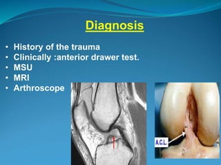 Diagnosis
• History of the trauma
• Clinically :anterior drawer test.
• MSU
• MRI
• Arthroscope
 
