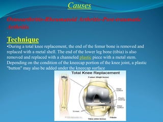 Causes
.
Osteoarthritis-Rheumatoid Arthritis-Post-traumatic
Arthritis
·
Technique
•During a total knee replacement, the end of the femur bone is removed and
replaced with a metal shell. The end of the lower leg bone (tibia) is also
removed and replaced with a channeled plastic piece with a metal stem.
Depending on the condition of the kneecap portion of the knee joint, a plastic
"button" may also be added under the kneecap surface
 