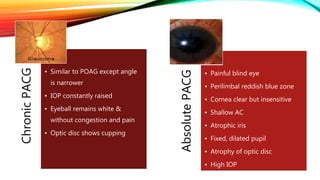 14. Primary glaucoma.pptx